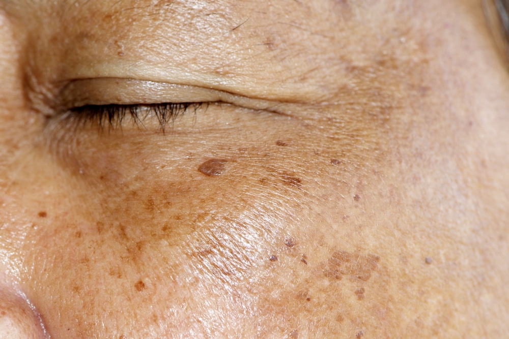 Melasma